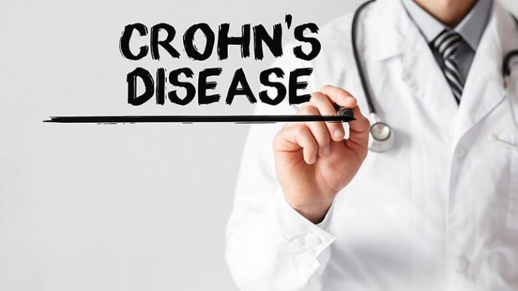Ani Kilo Kayıplarının Sebebi Crohn Hastalığı Olabilir…